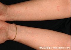 胆碱能性荨麻疹图片症状，细小剧痒的风团在运动受热时发病