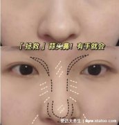 标准蒜头鼻图片，鼻子扁平鼻翼宽大肥厚(面相上存不住钱财)