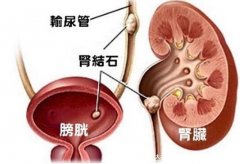 男女性肾结石会引起身体哪个部位疼痛图片，在腰部也可在下腹疼