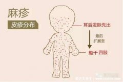 麻疹图片初期症状，红色斑疹从耳后蔓延至躯干(注意和幼儿急疹区分)