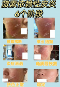 激素脸什么样子图片