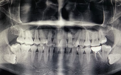为什么牙医总喜欢劝人拔智齿