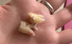 为什么有的牙齿有2个牙根有的没有