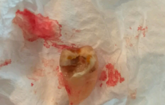 为什么说拔牙很伤身