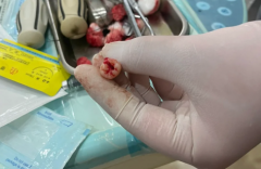 一次拔两颗智齿后悔死了