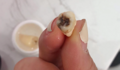 拔了一颗大牙后悔死了什么说法