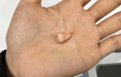 血凝块掉了一定会得干槽症吗